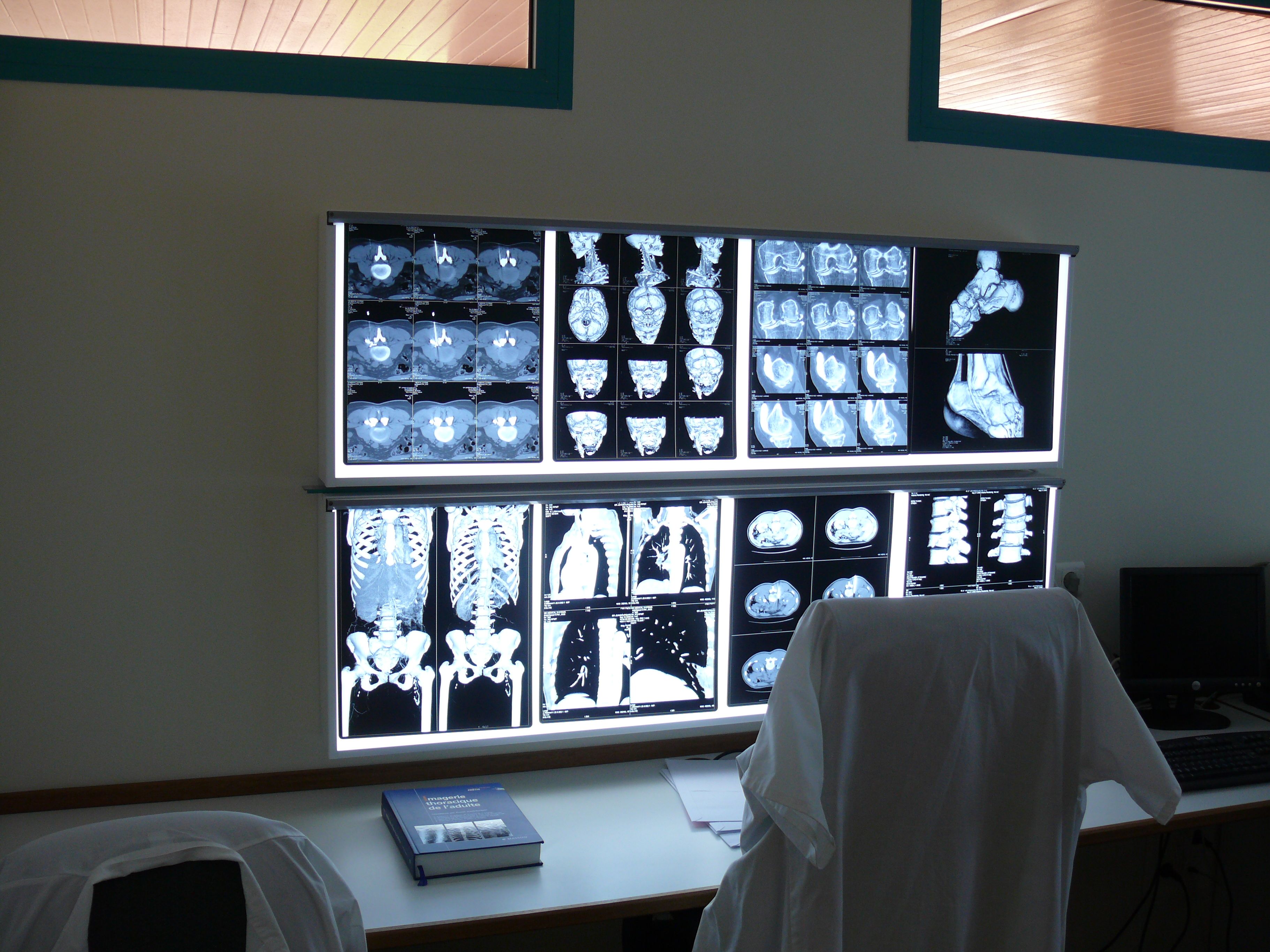 Роль негатоскопа у забезпеченні точного та якісного аналізу рентгенівських знімків